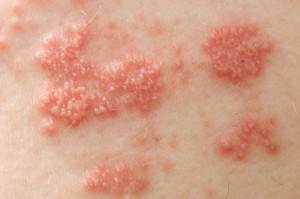 Chicken pox, shingle virus linked to giant cell arteritis